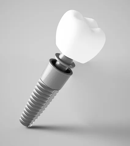 Implantes dentário