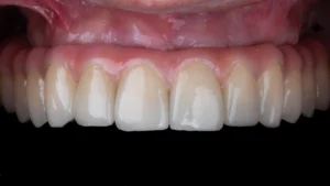 PRÓTESE DO TIPO PROTOCOLO ALL ON 4