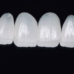 Lentes de contato dental em porcelana