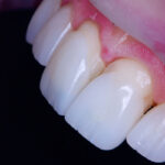 Teste antes da cimentação final