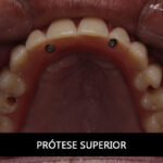 PROTESE-SUPERIOR