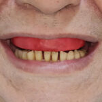 Antes - Dentes Inferiores