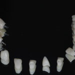 Prótese parcial e próteses unitárias fixas sobre implantes. Reabilitação em porcelana.